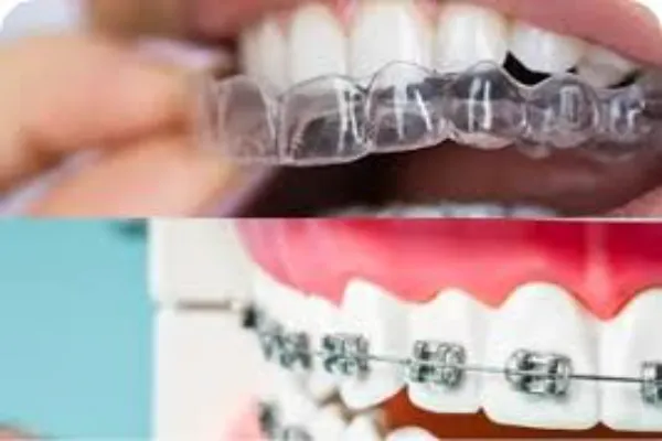 Braces vs Clear Aligners — Which is Right for You at a North Strathfield Clinic?