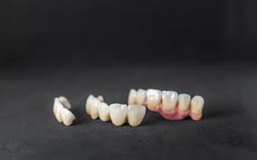 Can You Whiten Veneers? What Works, What Doesn’t & Best Alternatives
