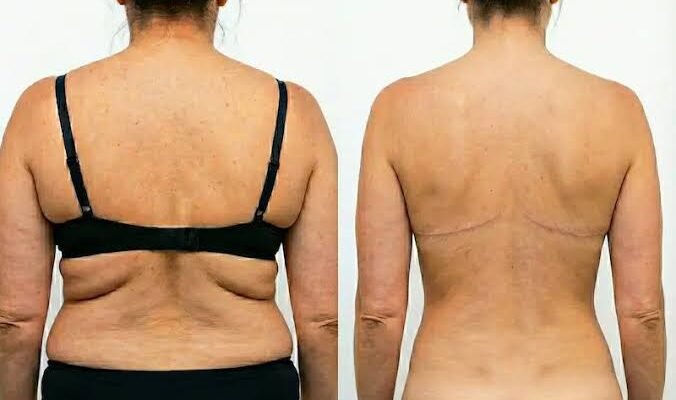 How Managing Tissue Elasticity Restores Long Term Upper Body Shape